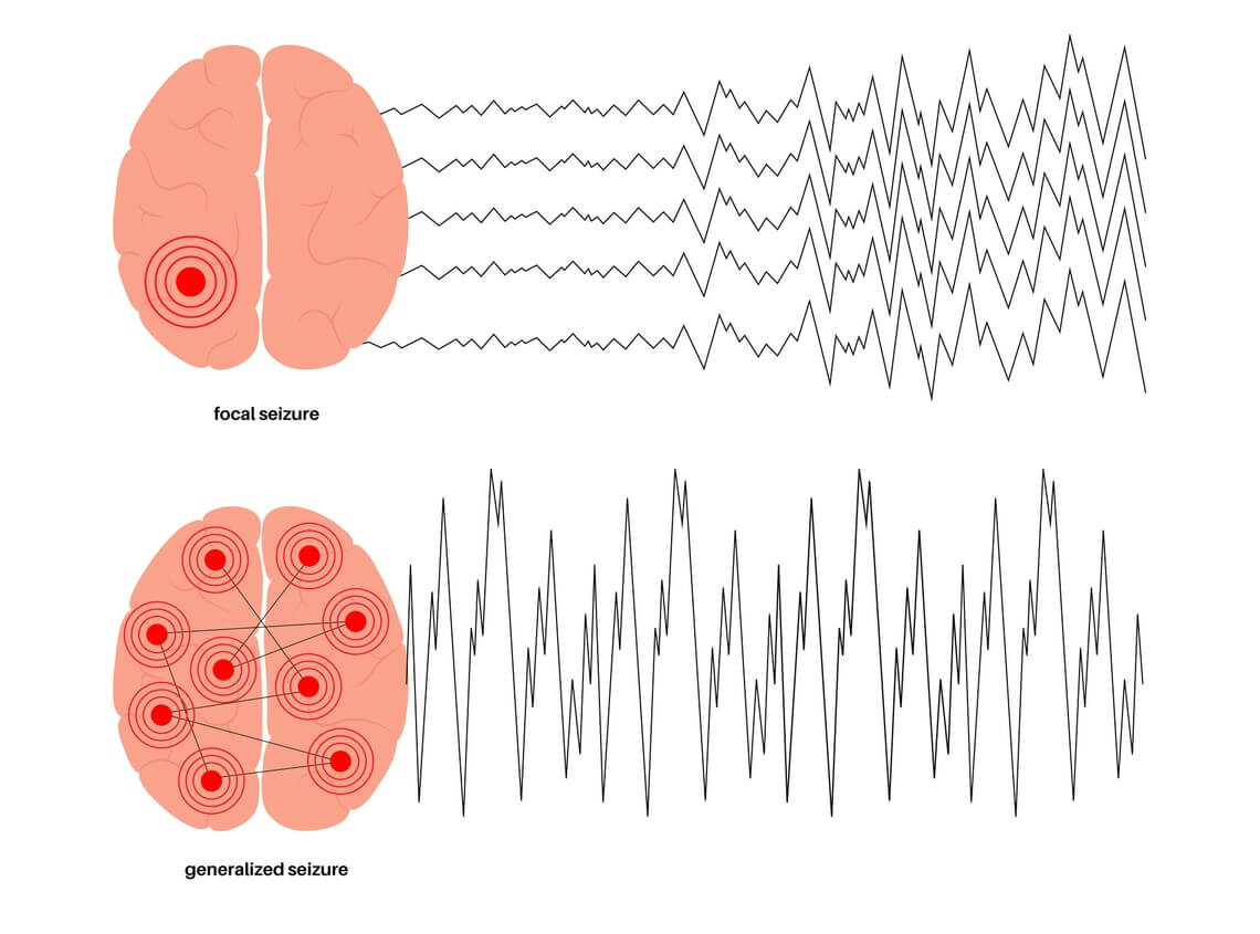 Epilepsy Porn